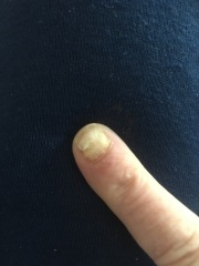 Does this look like a fungal nail infection?