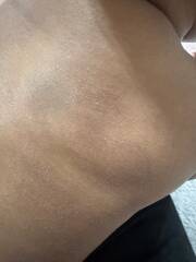 Baby’s dry skin patches – eczema or cow’s milk allergy?