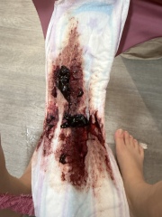 Blood trapped in womb after ERPC. Help!