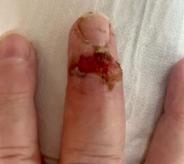 Slicing a potato and the top of my finger