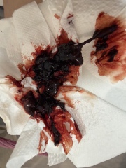 Blood trapped in womb after ERPC. Help!