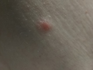 Odd spots on breast