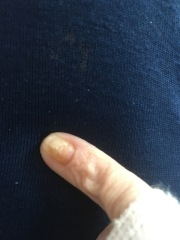 Does this look like a fungal nail infection?