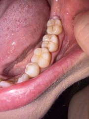 Any dentists around? What’s this at the back of my tooth?
